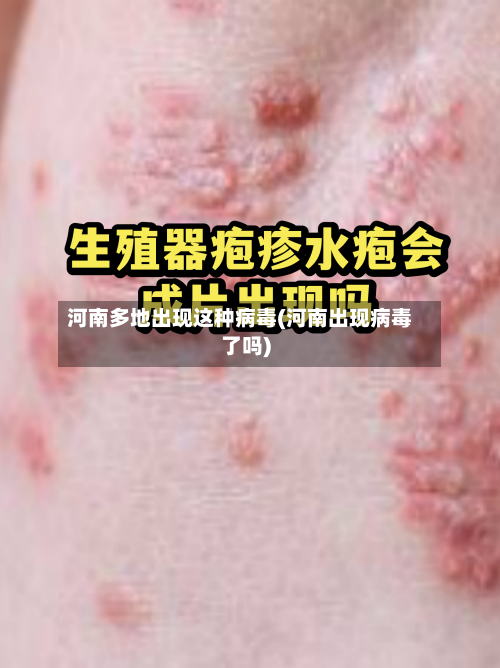 河南多地出现这种病毒(河南出现病毒了吗)